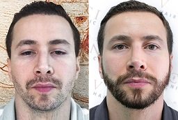 Beard Hair Transplant Before After