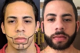 Beard Hair Transplant Before and After