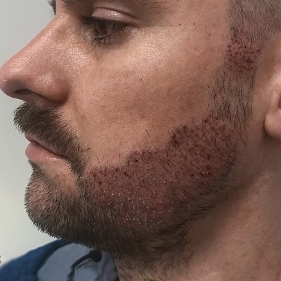 Beard Hair Transplant in Dubai