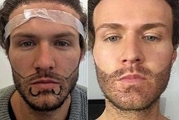 Before and After Beard Hair Transplant