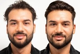 Before and After FUE Hair Transplant