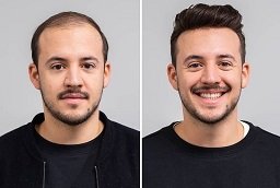 FUE Hair Transplant Before After