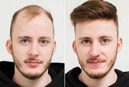 FUE Hair Transplant Before and After