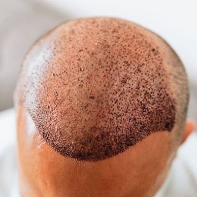 FUE Hair Transplant in Dubai