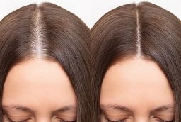Alopecia Areata Treatment Before After