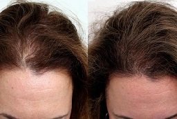 Alopecia Areata Treatment Before and After