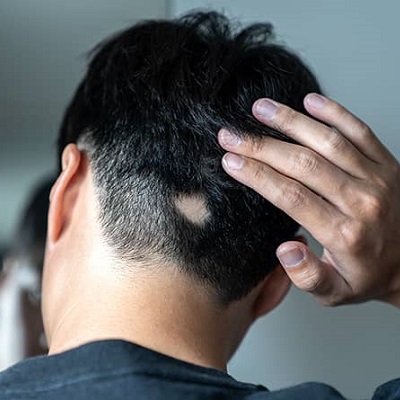 Alopecia Areata Treatment Cost in Dubai