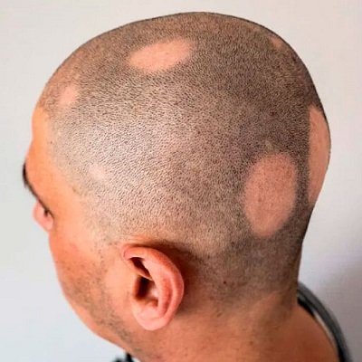 Alopecia Areata Treatment in Dubai