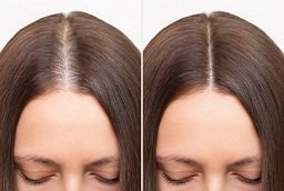 Before After for Stem Cell Hair Therapy