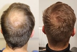 Before and After Crown Hair Transplant
