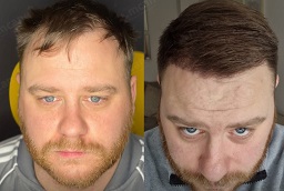 Before and After DHI Hair Transplant
