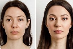 Before and After Eyebrow Hair Transplant