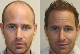 Before and After Front Line Hair Fixing