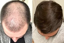 Before and After GFC Hair Transplant