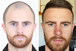 Before and After Hybrid Hair Transplant