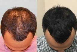Before and After Laser Hair Therapy