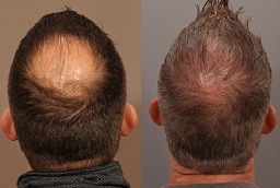 Before and After Robotic Hair Transplant