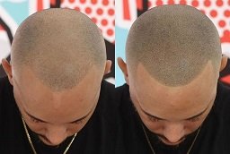 Before and After Scalp Micropigmentation