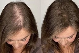 Before and After of Stem Cell Hair Therapy