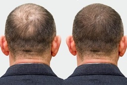 Body Hair Transplant Before and After