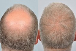 Crown Hair Transplant Before and After