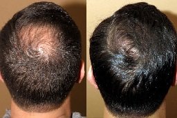 Crown Hair Transplant Before n After
