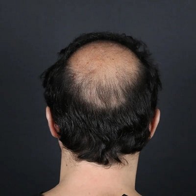 Crown Hair Transplant Cost in Dubai