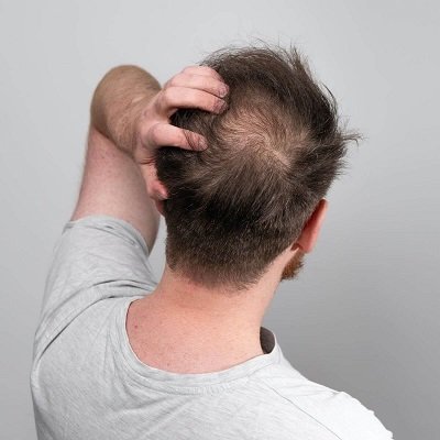 Crown Hair Transplant in Dubai