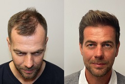 DHI Hair Transplant Before After