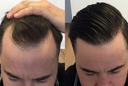 DHI Hair Transplant Before and After