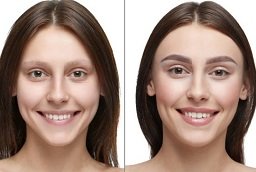 Eyebrow Hair Transplant Before After