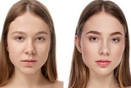 Eyebrow Hair Transplant Before and After