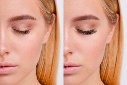 Eyelash Hair Transplant Before and After