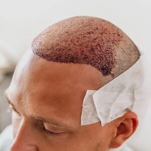 FUE Hair Transplant Cost in Dubai