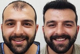 Front Line Hair Fixing Before After