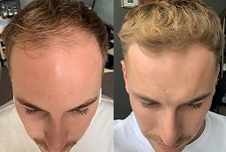 Front Line Hair Fixing Before and After