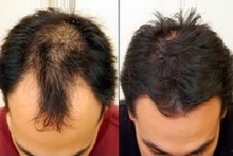 GFC Hair Transplant Before After