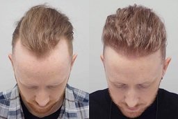 GFC Hair Transplant Before and After