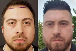 Hybrid Hair Transplant Before and After