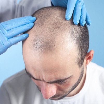 Hybrid Hair Transplant in Dubai