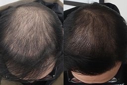 Laser Hair Therapy Before After