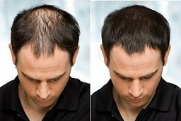 Laser Hair Therapy Before and After
