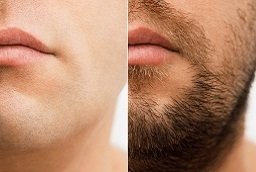 Mustache Hair Transplant Before After