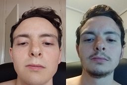 Mustache Hair Transplant Before and After