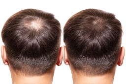 Robotic Hair Transplant Before After