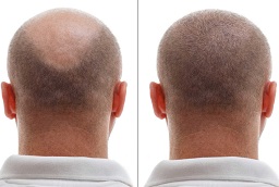 Robotic Hair Transplant Before and After