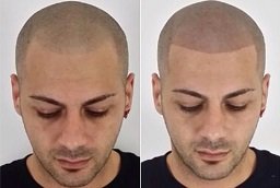 Scalp Micropigmentation Before and After