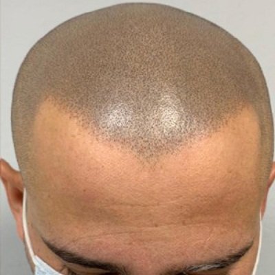 Scalp Micropigmentation in Dubai