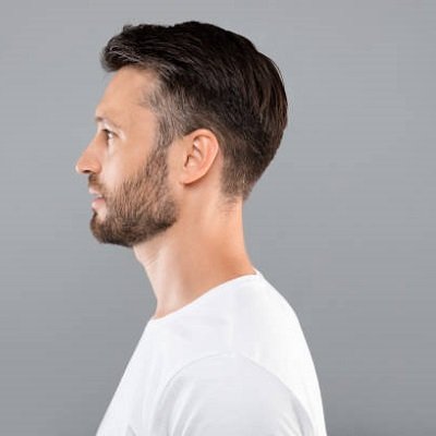 Sideburn Hair Transplant in Dubai