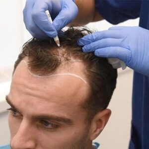 Front Line Hair Fixing Cost in Dubai